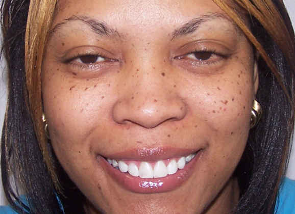 Cosmetic Bonding Renee H. - After