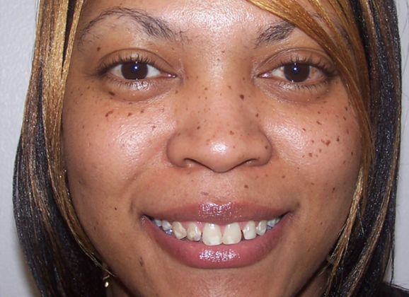 Cosmetic Bonding Renee H. - Before