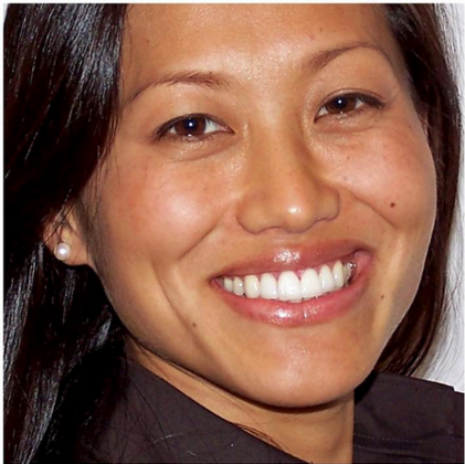 Veneers: Yoon I. - After