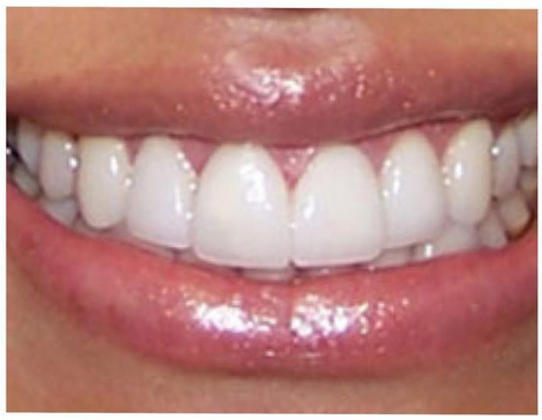 Veneers: Yoon I. - After