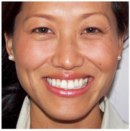 Veneers: Yoon I. - Before