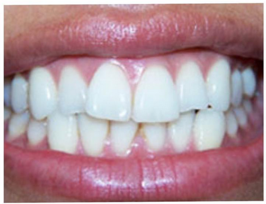 Veneers: Yoon I. - Before