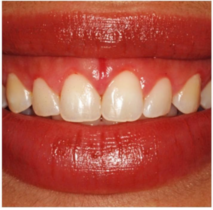 Laser Dentistry - Gummy Smile: Betsy D. - After