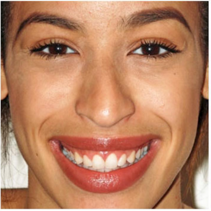 Laser Dentistry - Gummy Smile Betsy D. - After