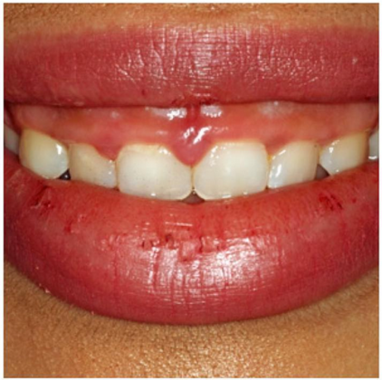 Laser Dentistry - Gummy Smile: Betsy D. - Before