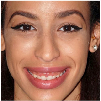 Laser Dentistry - Gummy Smile Betsy D. - Before