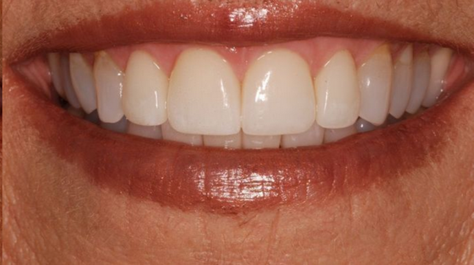 Invisalign: Deborah B. - After