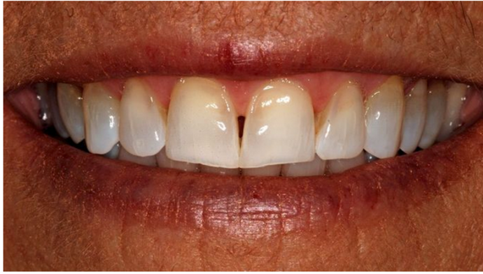 Invisalign: Deborah B. - Before