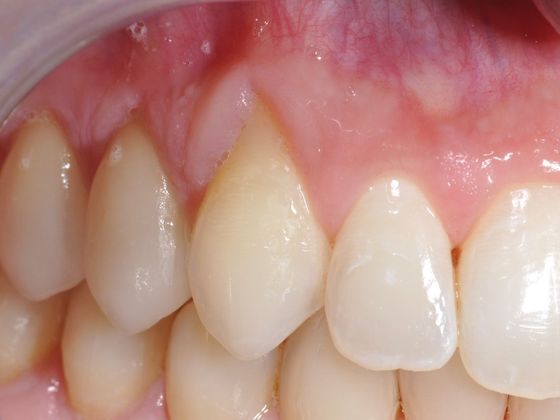 Gingival Tissue Graft (Recession) Case 1 - Before