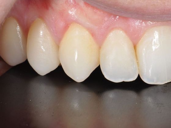 Gingival Tissue Graft (Recession) Case 1 - After