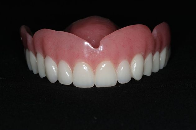 Dentures: Case 7 - Upper Denture