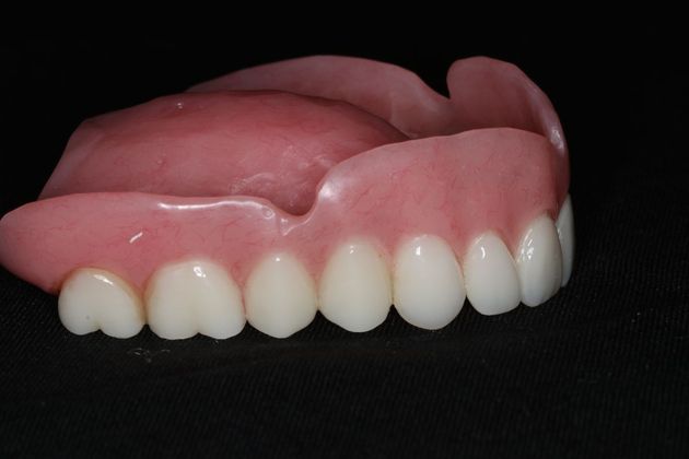 Dentures: Case 7 - Upper Denture