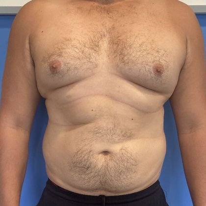 Liposuction: Case 17 Liposuction Scarsdale, NY - Before
