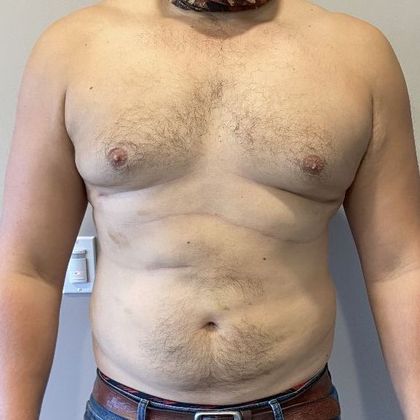 Liposuction: Case 17 Liposuction Scarsdale, NY - After