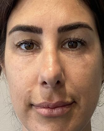 Rhinoplasty Case 31 Rhinoplasty Greenwich, CT - Before