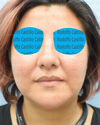 Bichatectomy (Cheek fat pad removal): Bichat + Chin implant + Neck lipo + Rhinoplasty - After