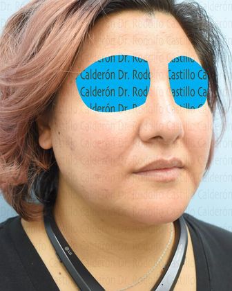 Bichatectomy (Cheek fat pad removal): Bichat + Chin implant + Neck lipo + Rhinoplasty - After