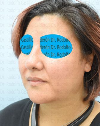 Bichatectomy (Cheek fat pad removal): Bichat + Chin implant + Neck lipo + Rhinoplasty - After