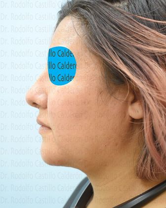 Bichatectomy (Cheek fat pad removal): Bichat + Chin implant + Neck lipo + Rhinoplasty - After