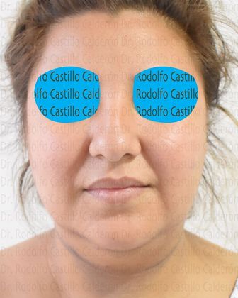 Bichatectomy (Cheek fat pad removal): Bichat + Chin implant + Neck lipo + Rhinoplasty - Before