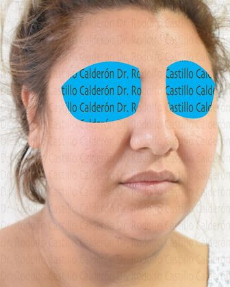 Bichatectomy (Cheek fat pad removal): Bichat + Chin implant + Neck lipo + Rhinoplasty - Before