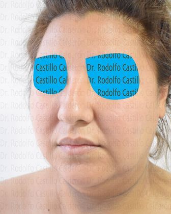 Bichatectomy (Cheek fat pad removal): Bichat + Chin implant + Neck lipo + Rhinoplasty - Before