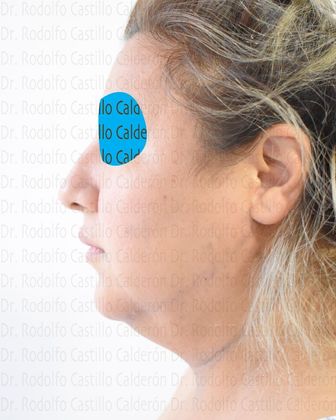 Bichatectomy (Cheek fat pad removal): Bichat + Chin implant + Neck lipo + Rhinoplasty - Before