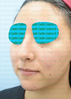 Bichatectomy (Cheek fat pad removal): Bichatectomy + Rhinoplasty + Chin implant - Before