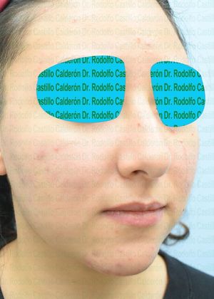 Bichatectomy (Cheek fat pad removal): Bichatectomy + Rhinoplasty + Chin implant - Before