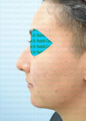 Bichatectomy (Cheek fat pad removal): Bichatectomy + Rhinoplasty + Chin implant - Before
