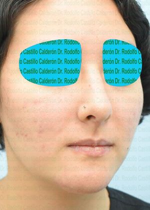 Bichatectomy (Cheek fat pad removal): Bichatectomy + Rhinoplasty + Chin implant - After