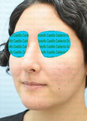 Bichatectomy (Cheek fat pad removal): Bichatectomy + Rhinoplasty + Chin implant - After