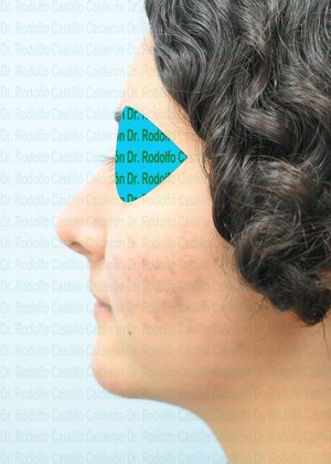 Bichatectomy (Cheek fat pad removal): Bichatectomy + Rhinoplasty + Chin implant - After
