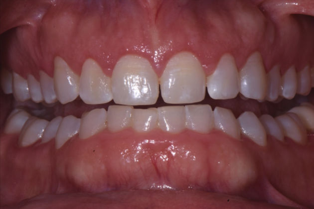 Esthetic Contouring Case