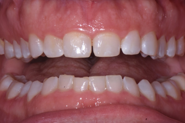 Esthetic Contouring: Case 1 - Before