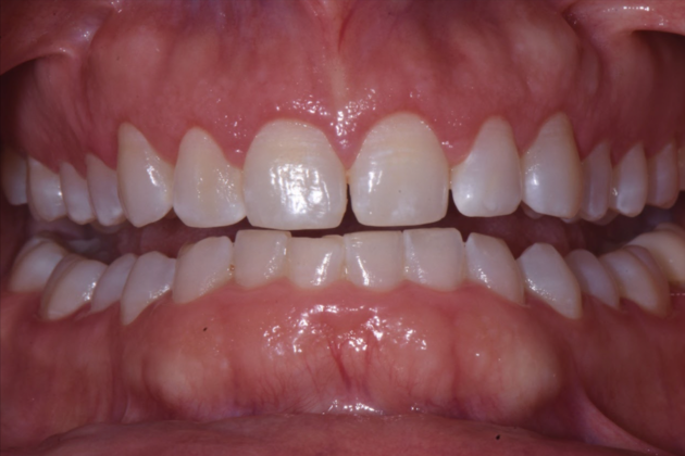 Esthetic Contouring: Case 1 - After