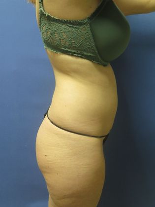 Brazilian Butt Lift: Case 9 - Before