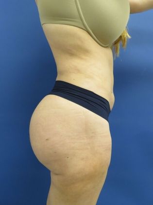 Brazilian Butt Lift: Case 9 - After