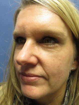 Brow Lift: Case 1 - After