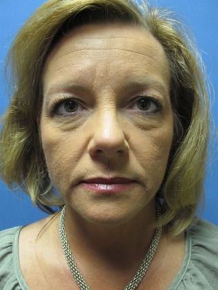 Brow Lift Case 3 - Before