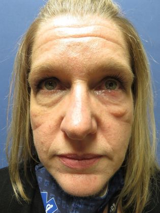 Eyelid Surgery (Blepharoplasty) Case 1 - Before