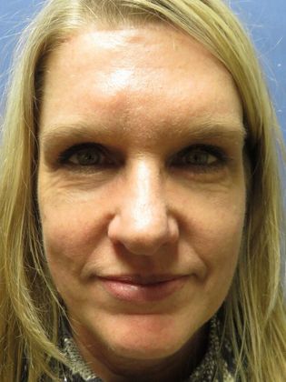 Eyelid Surgery (Blepharoplasty) Case 1 - After