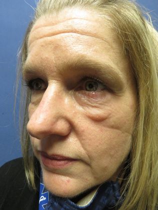 Eyelid Surgery (Blepharoplasty): Case 1 - Before