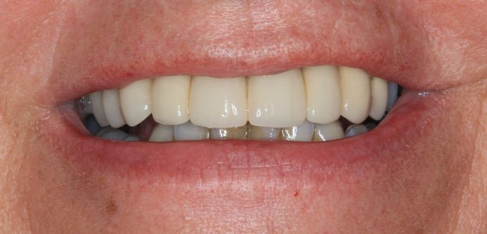 Hybrid Implant Dentures: Case 5 - Before Implant Dentures