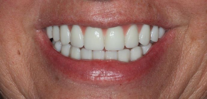 Hybrid Implant Dentures: Case 5 - After Implant Dentures