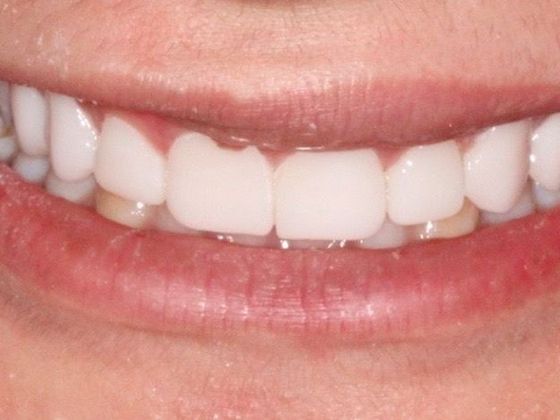 Veneers Case 1 - After