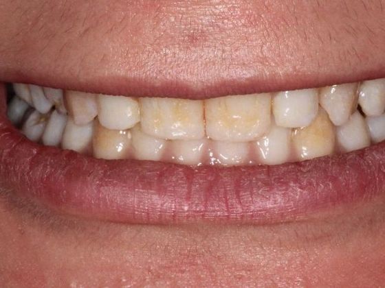 Veneers Case 1 - Before