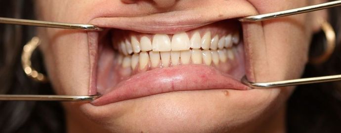 Dental Bonding Case 1 - After