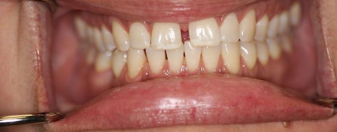 Dental Bonding Case 1 - Before
