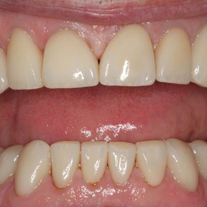 after dental care